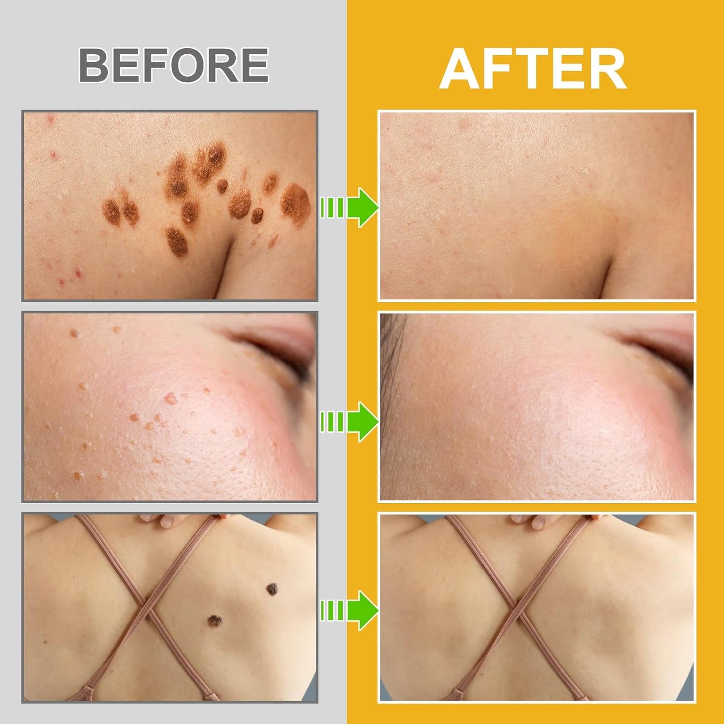 Bee Venom Moles and Warts Removal Cream